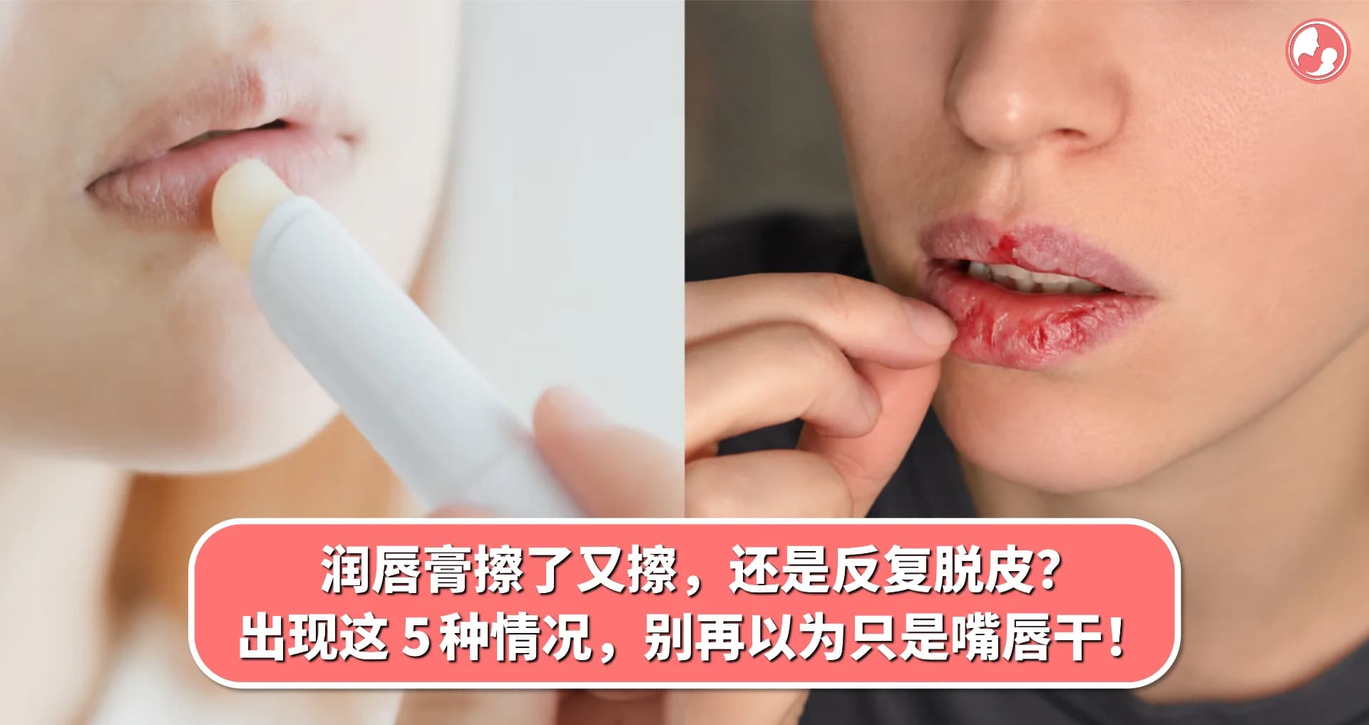 润唇膏擦了又擦,还是反复脱皮?出现这 5 种情况,别再以为只是嘴唇干!