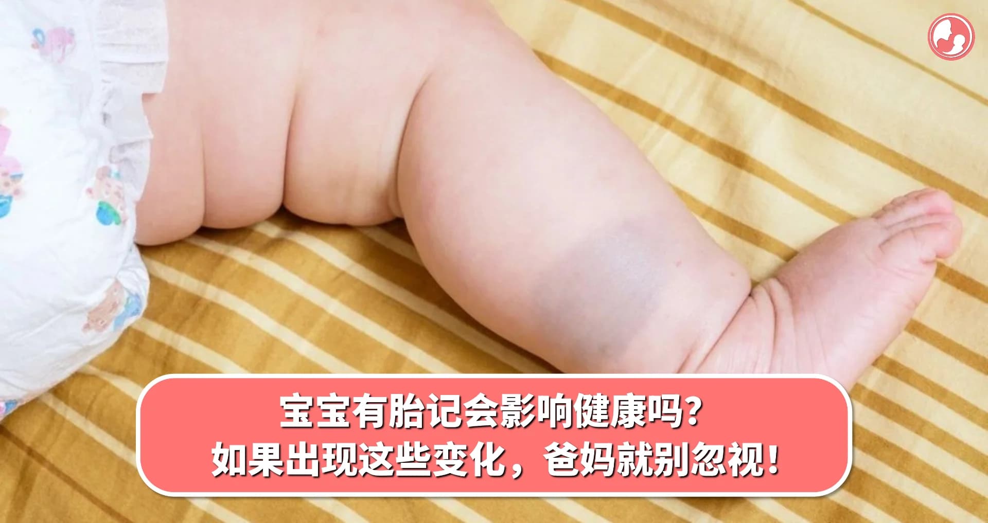 【胎记篇】宝宝有胎记会影响健康吗?如果出现这些变化,爸妈就别忽视!